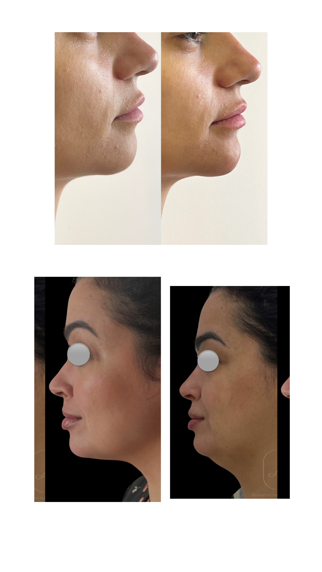 Antes e Depois - Perfil