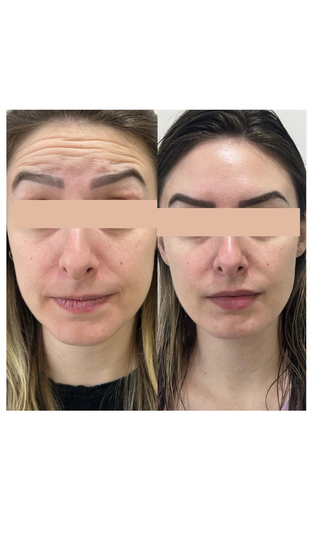 Antes e Depois - Testa